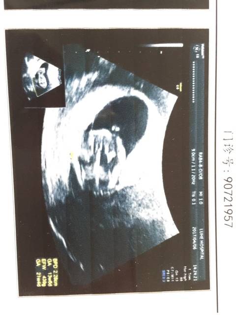 NT通过,帮我看看胎儿的姿势,我什么都看不懂。