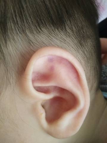 6个月宝宝耳朵紫色斑点_宝宝耳朵突然长了两