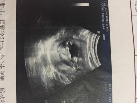 b超检查三线一定是女宝吗?