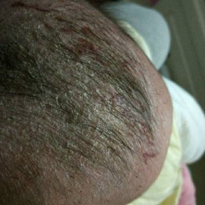 宝五个月,湿疹较重,脸上脖子都是红红的头上很