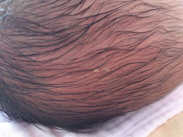 新生儿头上长了几个痘痘!是毛囊炎还是疖子?_