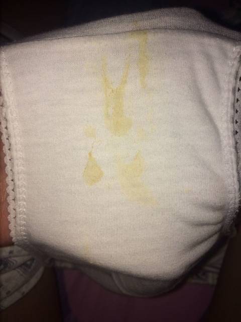 3个月了,黄褐色白带,请问各位姐妹是什么情况