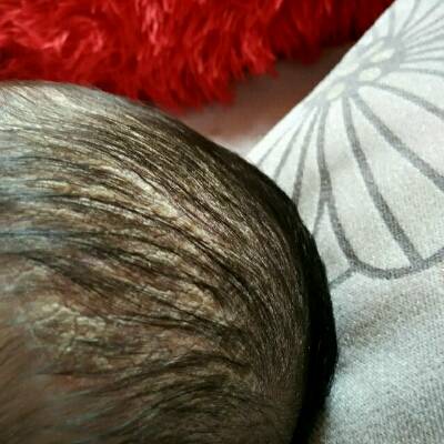 四个多月宝宝头上长白色类似头皮屑的东西,用
