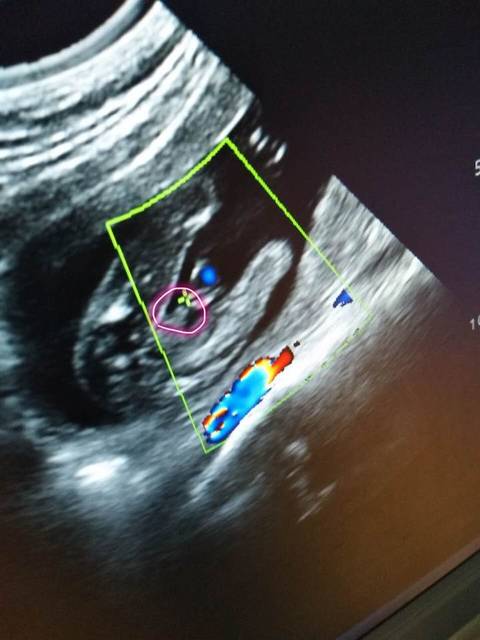 看看这是男孩的小鸡鸡吗_16周整b超做的是女孩