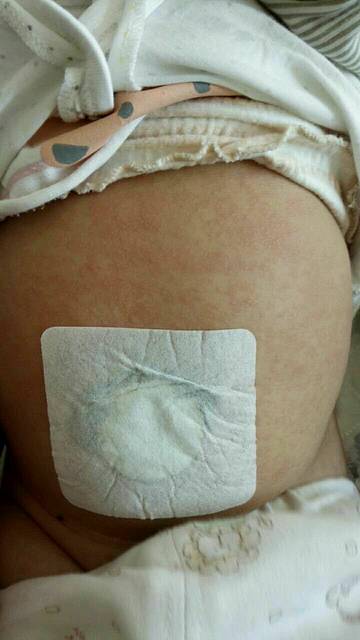 4个月幼儿急疹纪录(附照片)