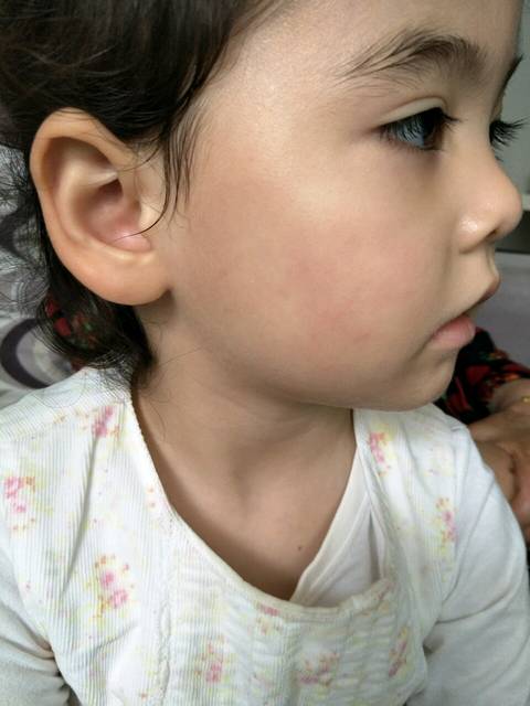 3岁半小女孩被紫外线晒伤后,皮肤容易发红过敏