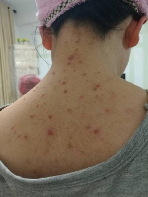 孕后，前胸后背痘痘不停长_怀孕后，开始发现前胸后背的痘痘没消_宝宝树