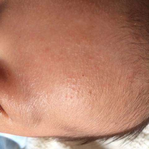 宝宝脸上长了很多小米粒一样的小疙瘩_宝宝脸