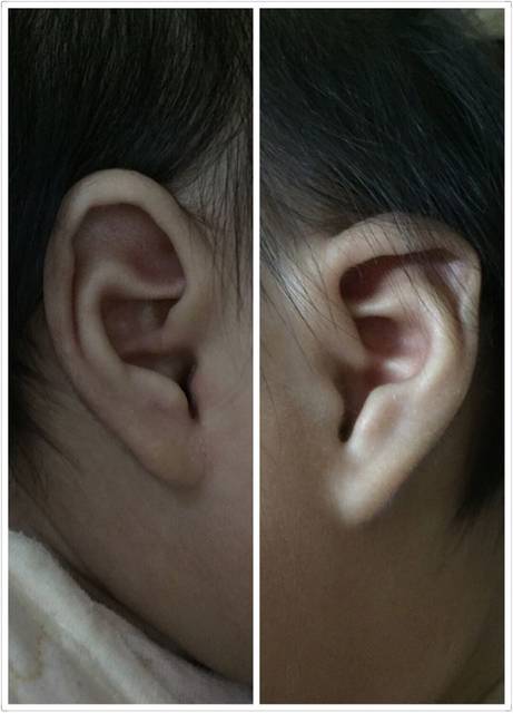 宝宝耳朵不一样_宝妈们,我家女宝宝85天左右,