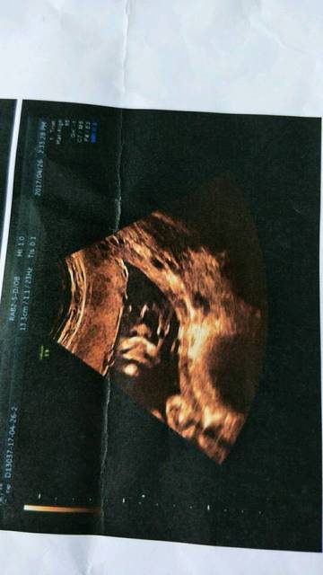 四维彩超宝宝吐舌头。NF增厚。怎么办_24周查