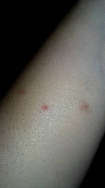 胳膊上长小红疙瘩