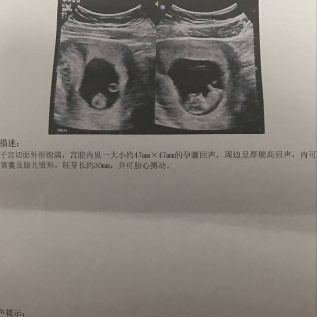 孕十周检查 看到宝宝啦_孕七周做B超就有胎心