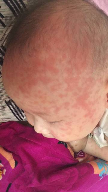 六个月宝宝发烧五天出红疹