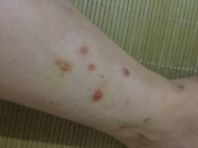 孕期长湿疹怎么办?