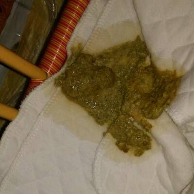 我家宝宝六个月换了2段奶一直拉肚子,有奶瓣,拉肚