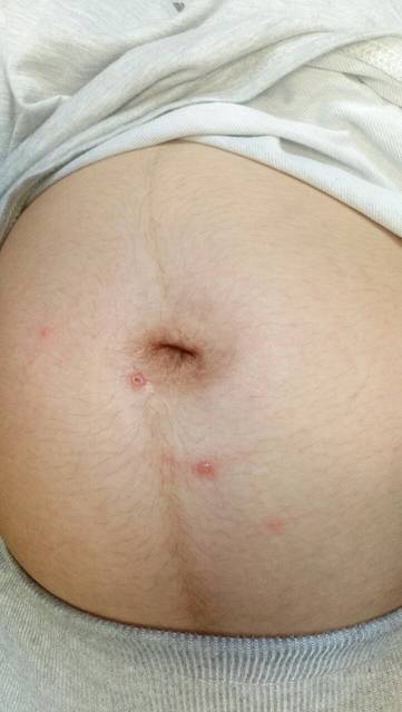 怀孕八个月身上突然长红点脓包是怎么回事?