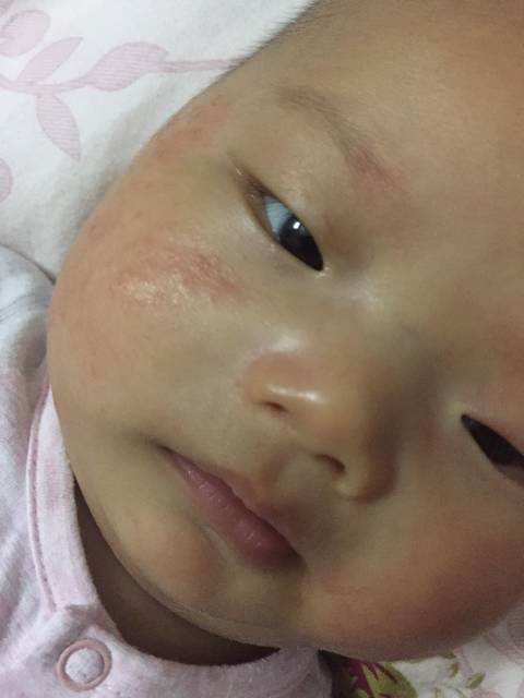 请问我家宝宝脸上长的是湿疹还是奶疹还是什么