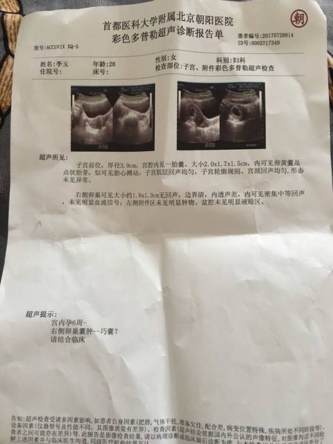 巧囊是什么_巧克力囊肿的治疗方法
