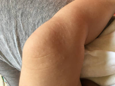亲们知道这是什麼么,是湿疹么,腿上胳膊上都有,宝宝40天