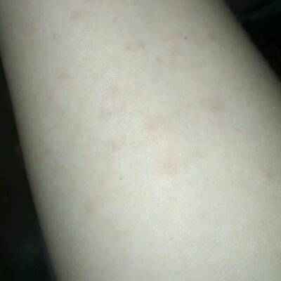 有宝妈身上长这种红疹子的吗?手臂被蚊子咬了