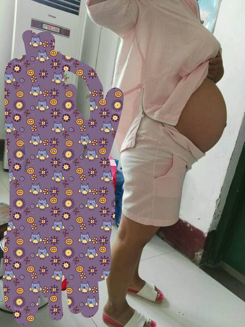 二胎预产期9月1号,有一样的宝妈吗?剖腹产!