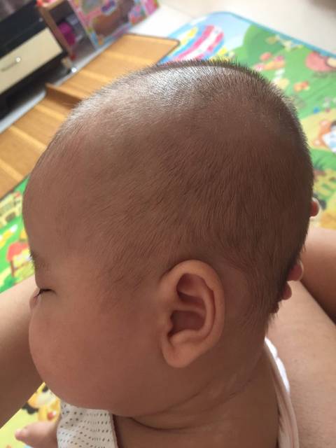 宝宝2个月,头顶尖后脑勺尖,请问有长好的吗?求