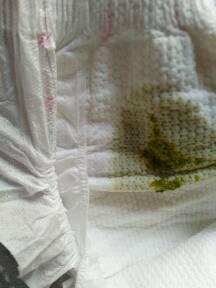 宝宝六个月了,拉肚子绿色的粑粑,'怎么回事啊,急