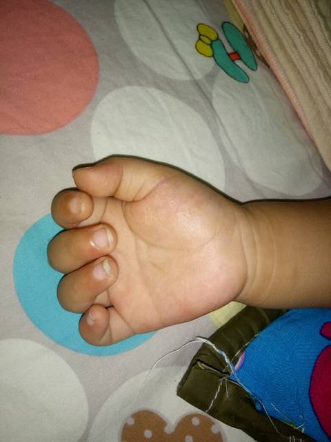 宝宝大拇指根部至手腕处青筋发紫红肿。宝妈知