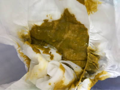 妈妈胃肠道不好,总是便便不成形,爱拉肚子,宝宝