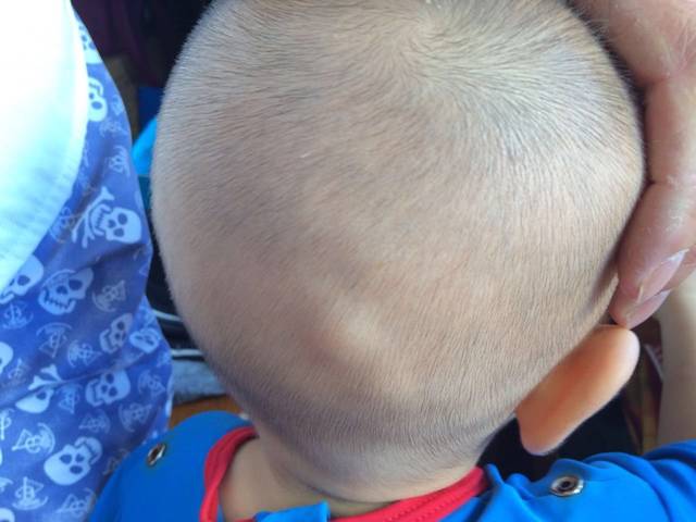 宝宝后脑勺长包