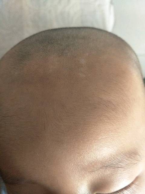 宝宝头皮上长了白斑,