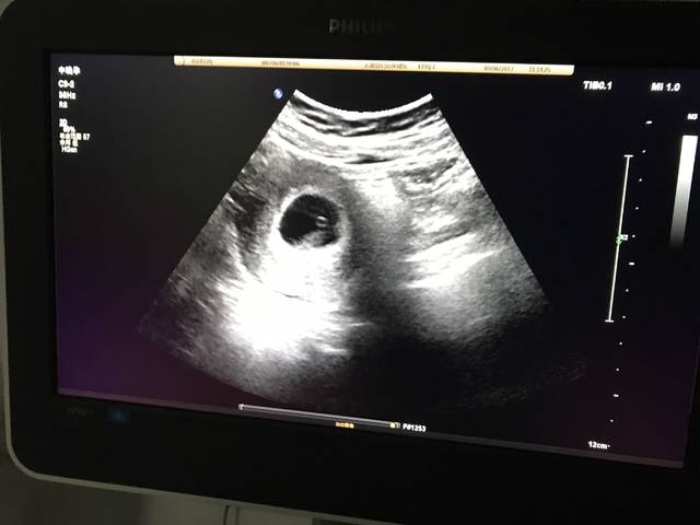 怀孕46天,已有胎心胎芽啦!胎心124_怀孕46天