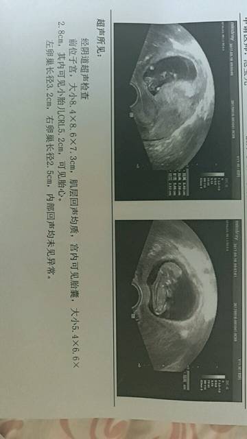 怀孕80天可以做无痛人流吗?需要住院吗?