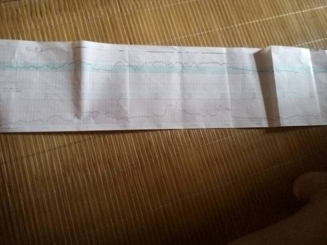 39周晚上宝宝动的频繁,胎监达到190怎么办?_