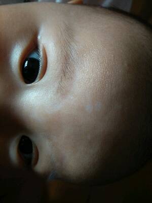 4个多月宝宝眉毛处皮肤有白色像癣一样的东西