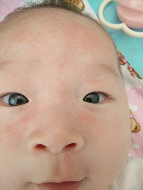 求助,帮忙看看宝宝脸上头上是湿疹还是痱子_求