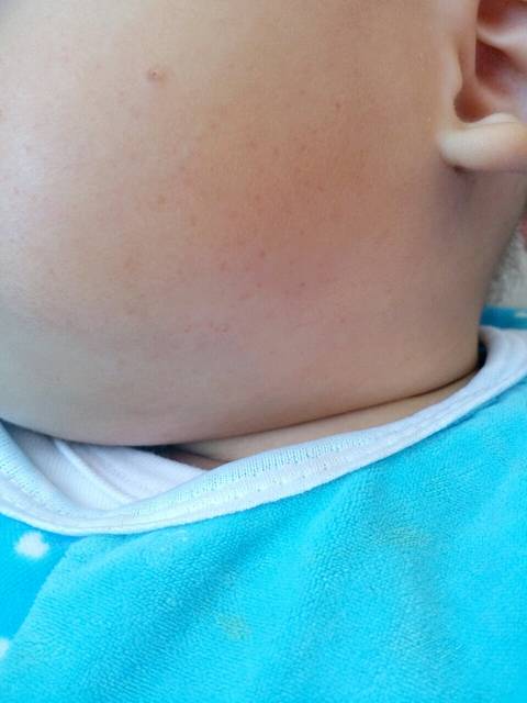 宝宝脸上皮肤里有小红点_宝宝今天脸上长了很
