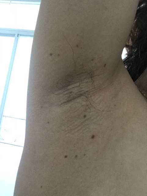 腋窝下突显黑色斑点状疙瘩 我都郁闷死了_孕十