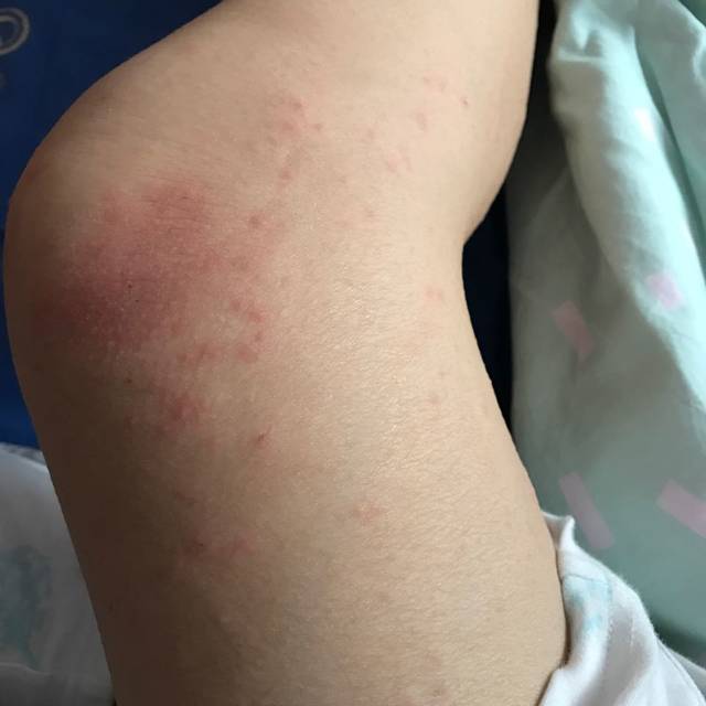 各位有经验的宝妈 我这个是湿疹还是荨麻疹?_