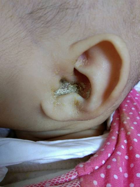 宝宝耳朵留黄水_宝宝耳朵里流黄水 婆婆去专门