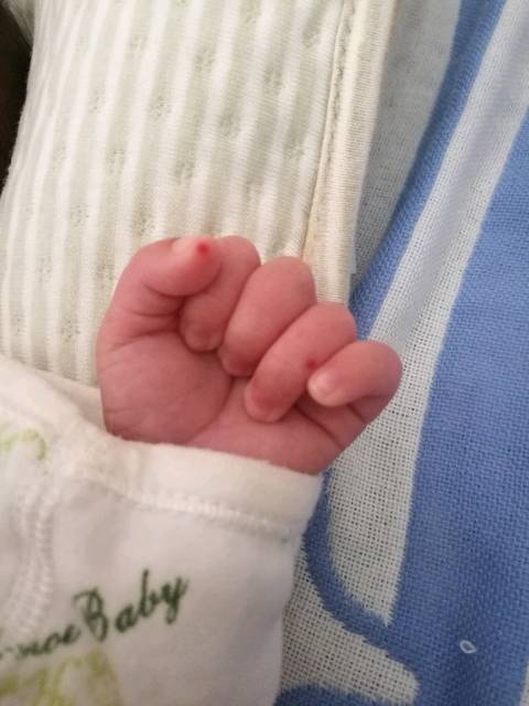 出生20多天宝宝手指有小红点,有遇到过的宝妈吗?