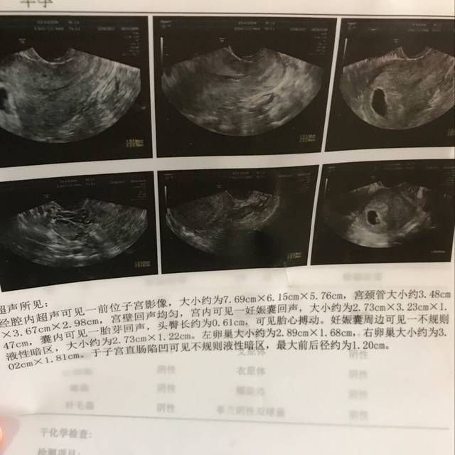 孕囊看男女_怀孕50天左右做B超,孕囊圆的是女女生蛋糕小游戏画图片