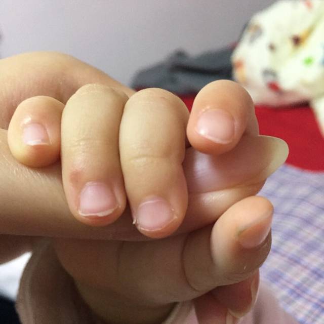 宝宝的指甲很容易劈 甲床越来越短
