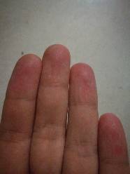 手指上起红点,让后变成泡再蜕皮,是皮肤病吗?