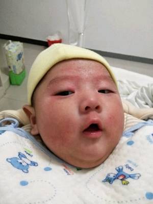 宝宝三个月,每次洗脸眼睛周边都发红,眼袋有时