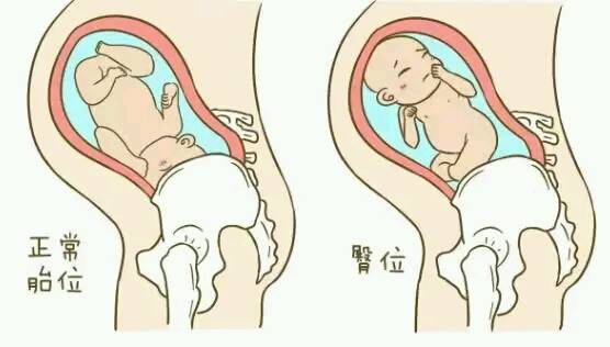 胎儿打嗝算胎动吗