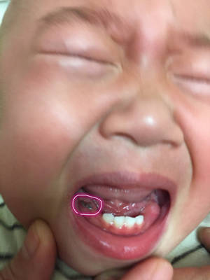 我家宝宝一岁正在出牙,前几天故牙包,今天看是