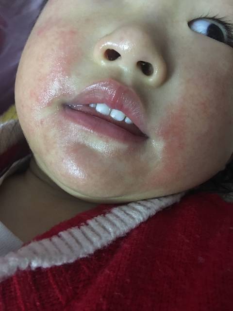 宝宝两岁了,可是脸上经常过敏,有类似的吗?