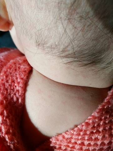 宝宝七个月了,之前发了两天烧,今天发现脸上,脖
