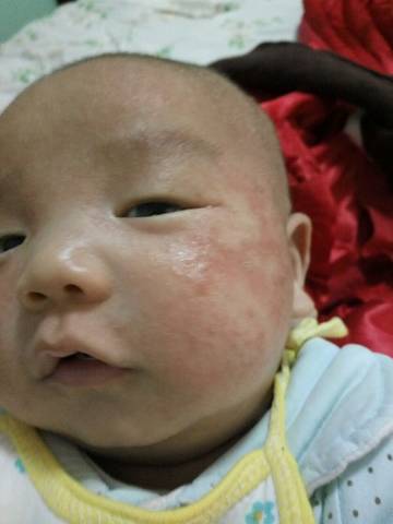 宝宝53天了,脸上一片一片起红疹,头上还起皮,是